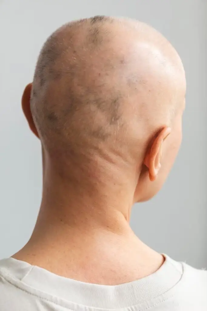 Alopecia