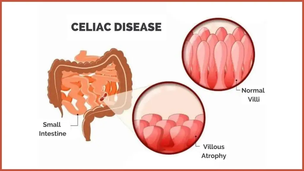 Celiac disease