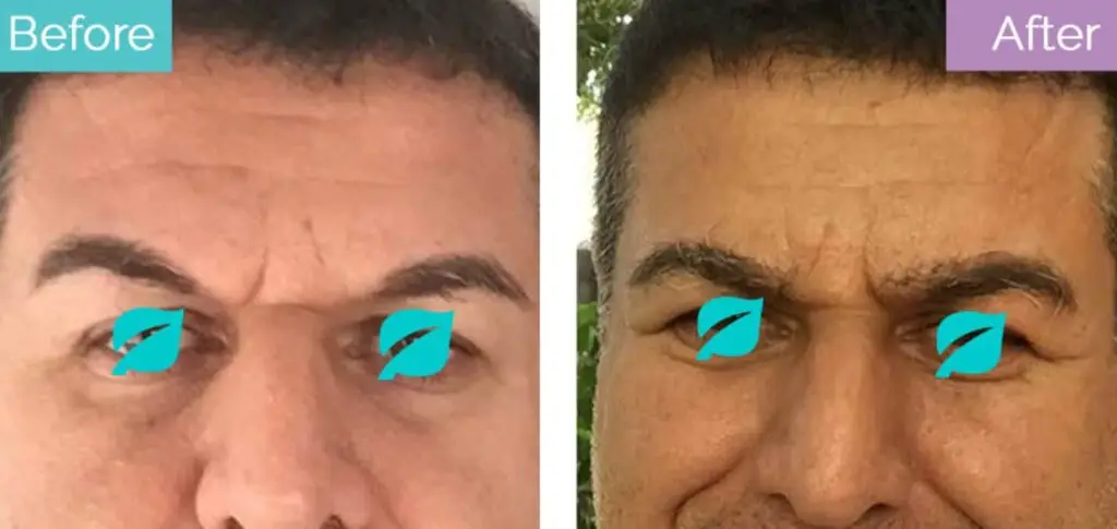 Eyebrow hair grafts