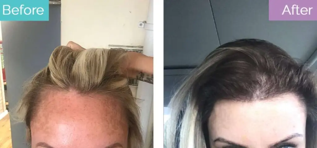 Female hair transplant