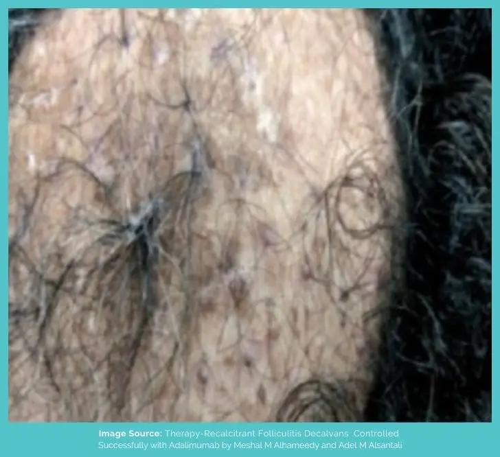 Folliculitis decalvans hair loss