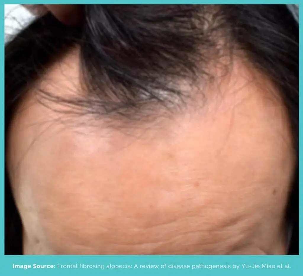 Frontal fibrosing alopecia