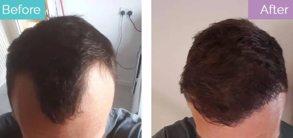 Hair transplant results