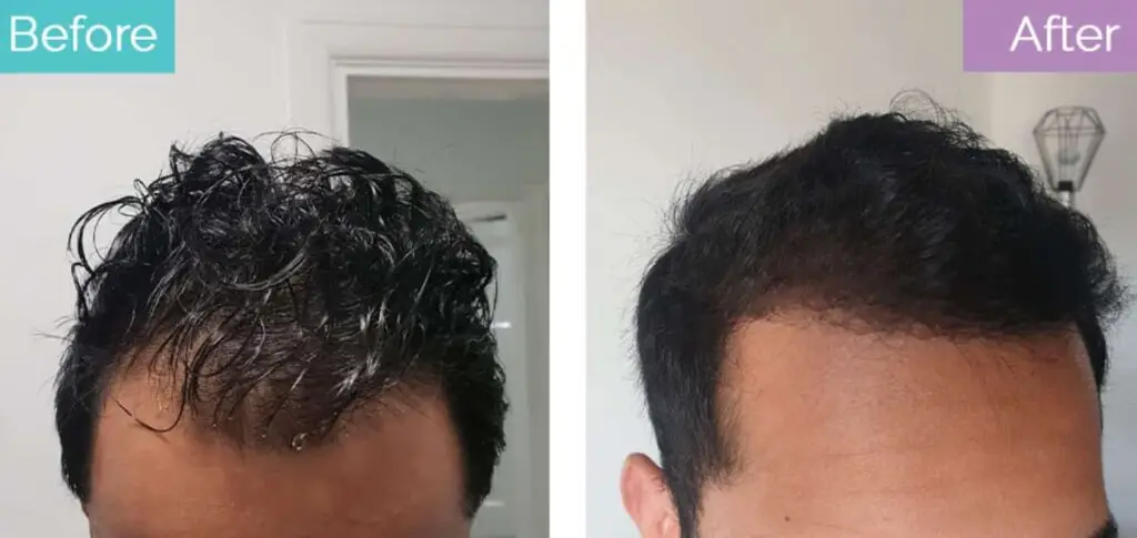 Hairline grafts