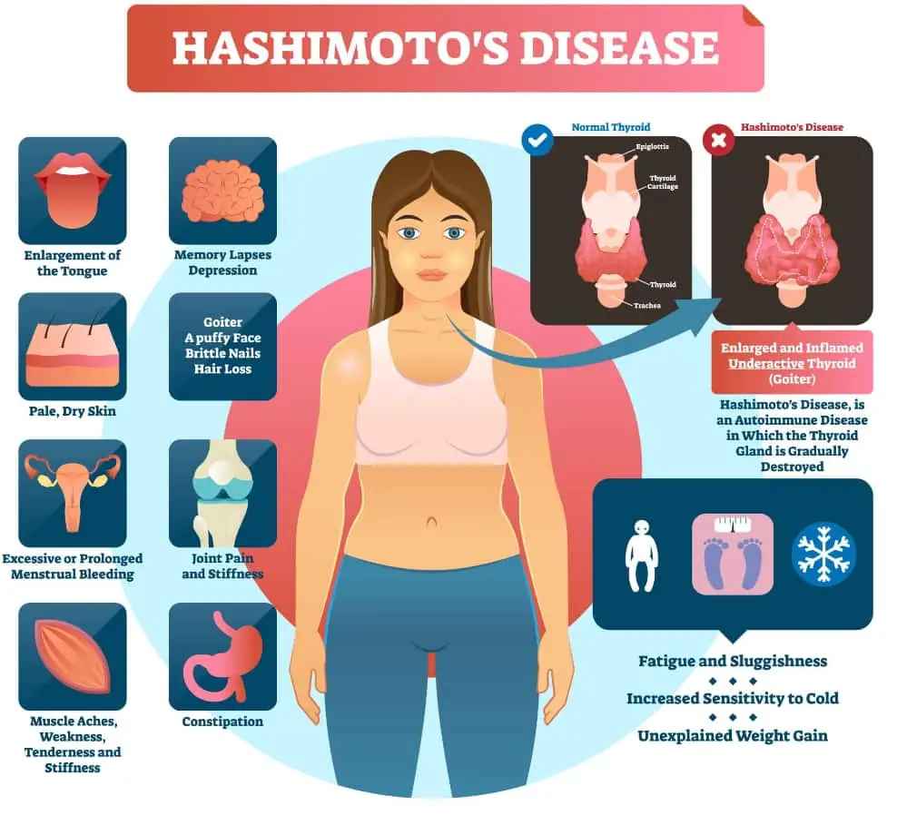 Hashimoto's symptoms