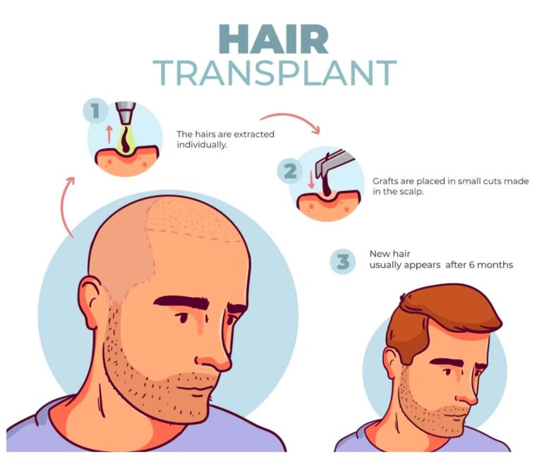 How Does A Hair Transplant Work | Longevita Hair Transplant