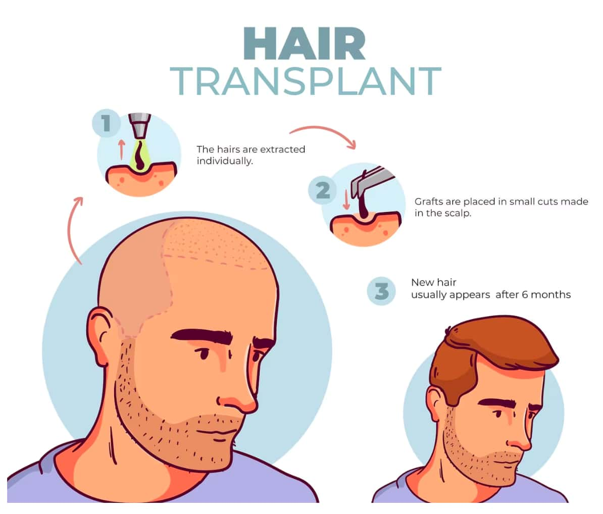 How Does A Hair Transplant Work | Longevita Hair Transplant