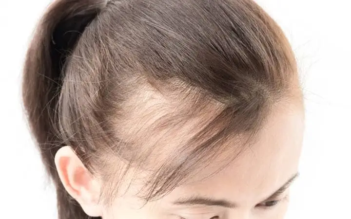 Traction alopecia