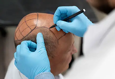 how does a hair transplant work