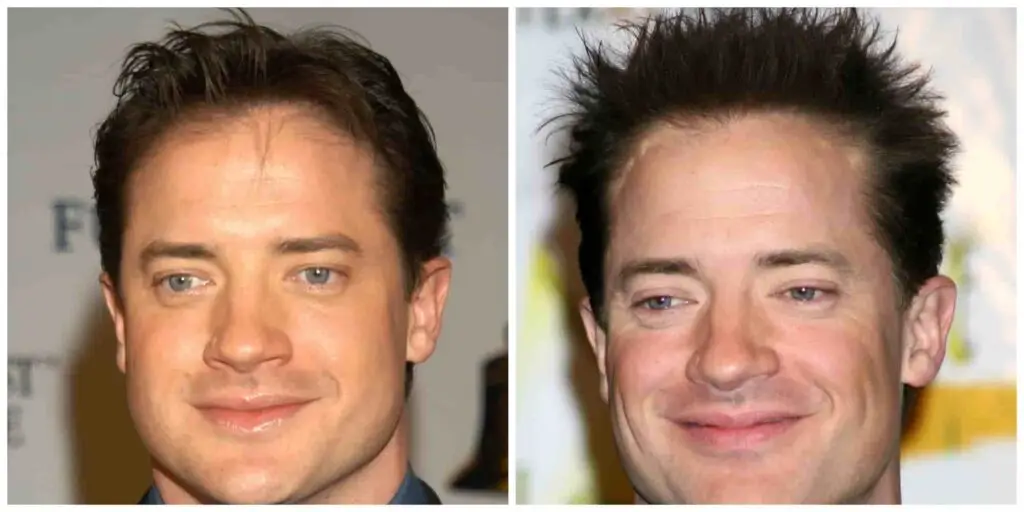 Brendan Fraser's hair before and after