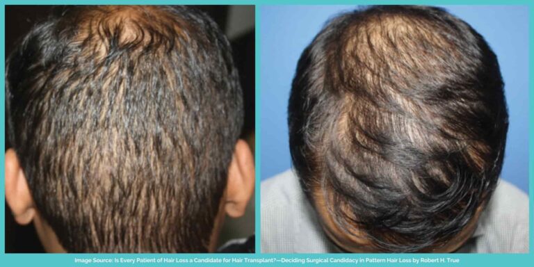 What Is Diffuse Hair Loss & How To Treat It? | Longevita