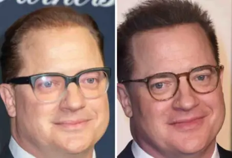 brendan fraser hair transplant