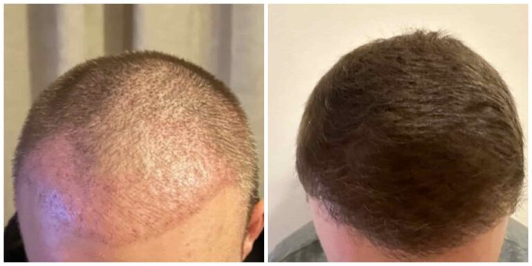 Autumn hair transplant results