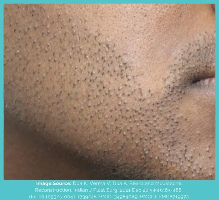 Beard hair transplant cobblestoning