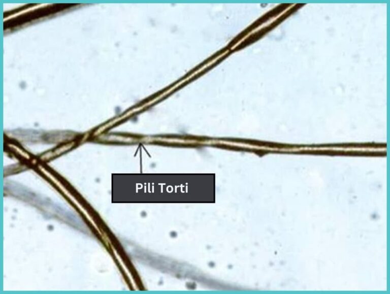 Pili Torti What It Is Causes And Treatments Longevita
