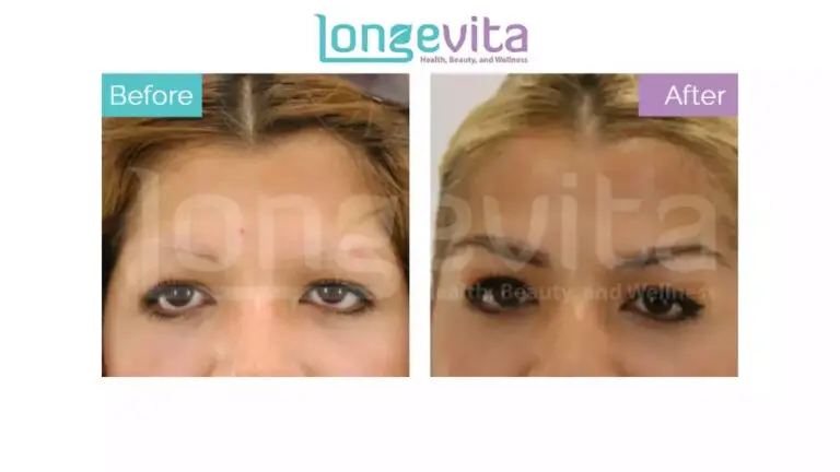 eyebrow hair transplant 1024x576