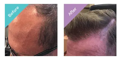 hair transplant before after