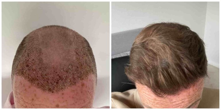 spring/summer hair transplant results