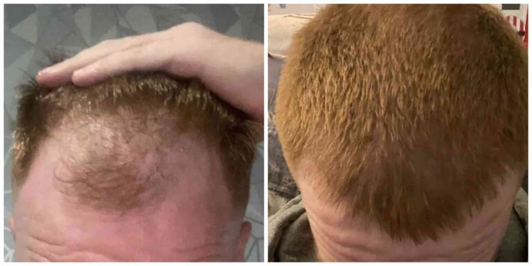 winter hair transplant results