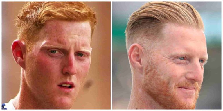 Ben stokes before and after hair transplant