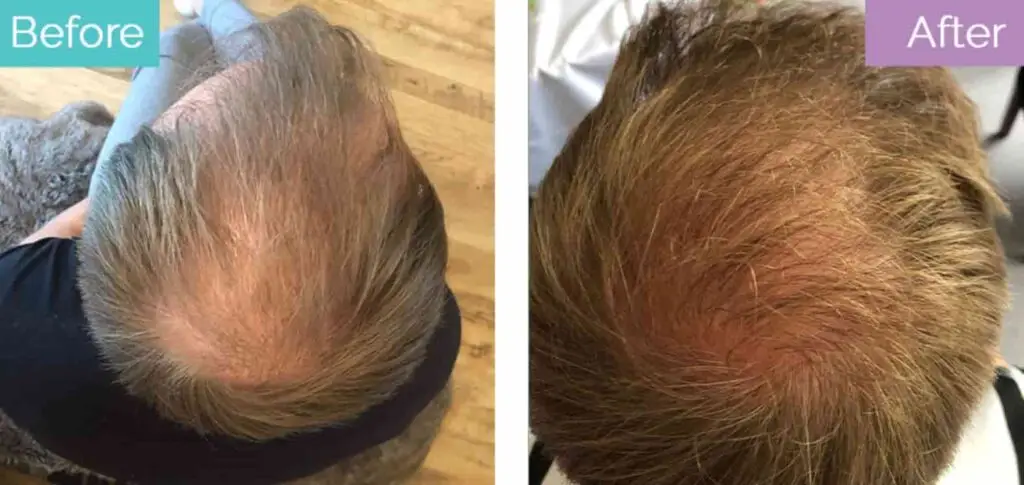 Crown hair transplant