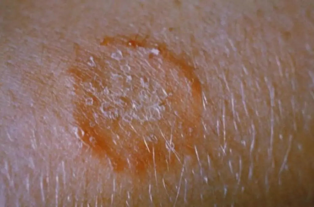 Ringworm on skin