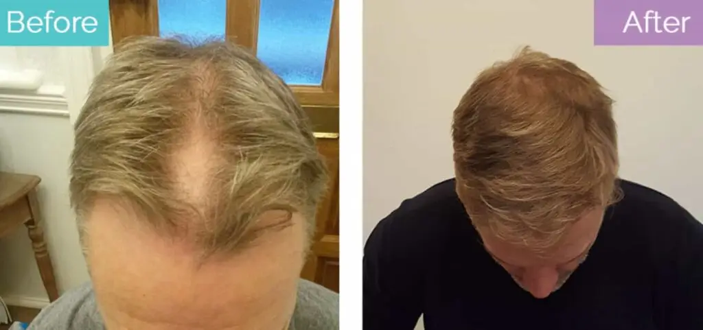 hair transplant in turkey