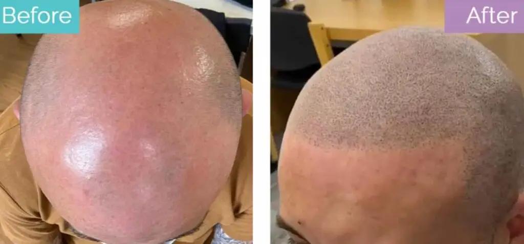 Scalp micropigmentation