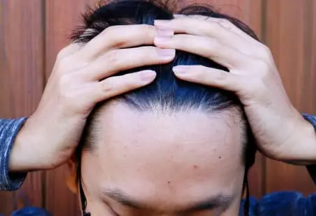 hairline lowering surgery