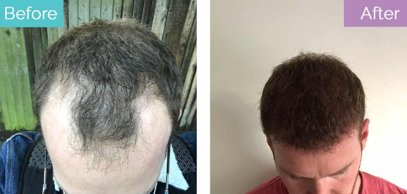 How Big Is A Hair Transplant With 3 000 Grafts Longevita