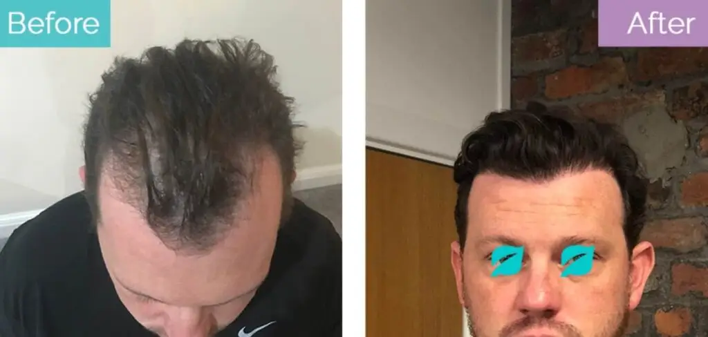 12 months after 3000 grafts transplant