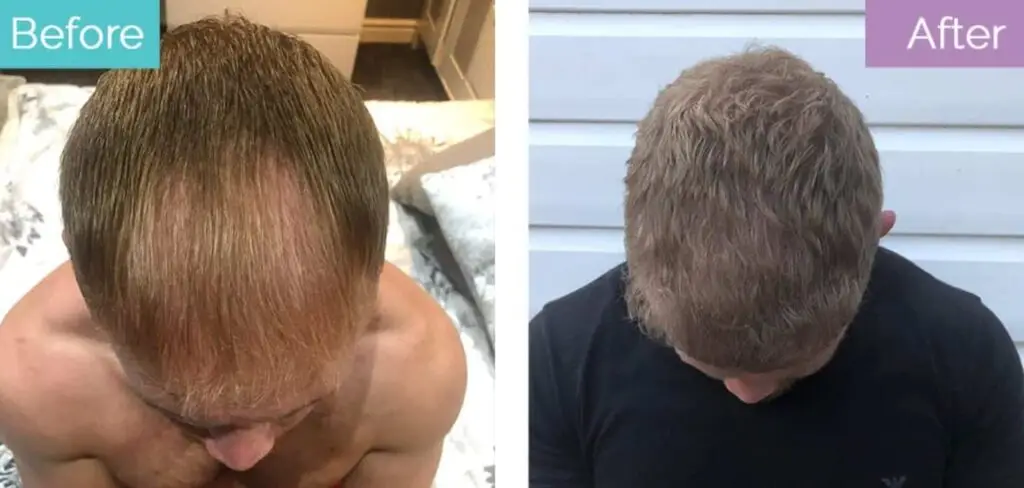 3,000 hair grafts transplant