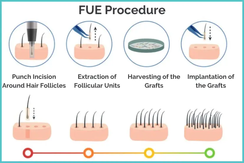 FUE Procedure