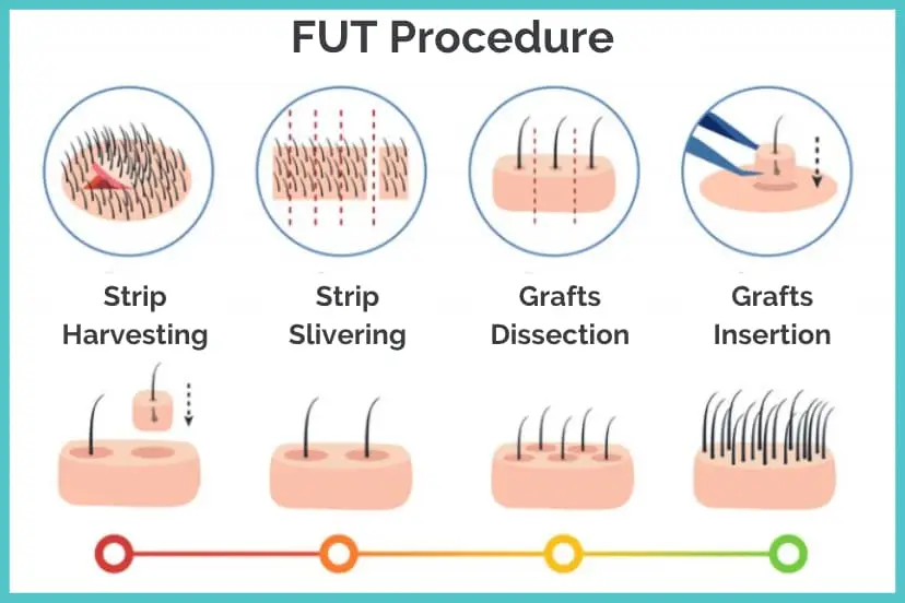 FUT Procedure