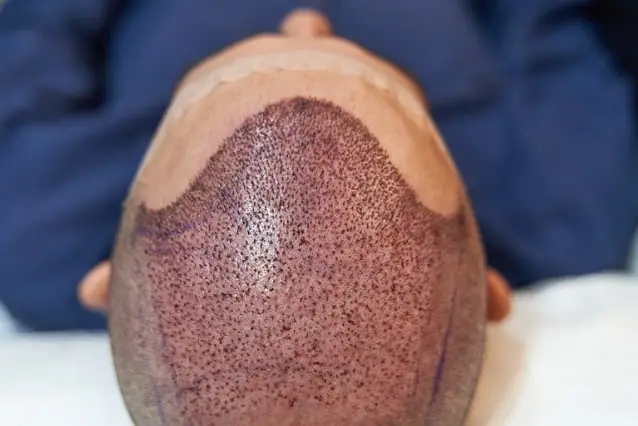 Hair transplant blood crusts