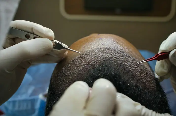 Hair transplant procedure