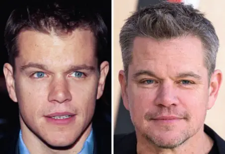 Matt damon hair transplant