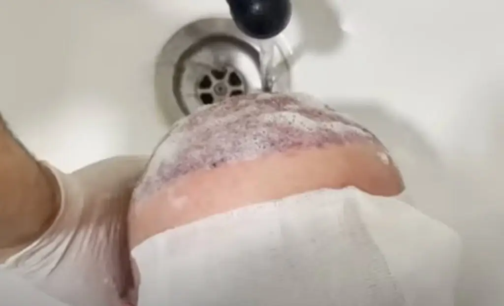 Washing scalp after hair transplant