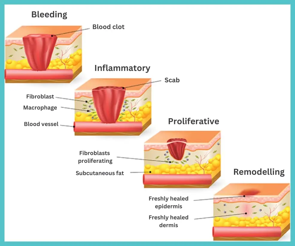 Wound healing