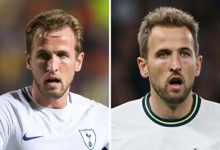 Harry Kane hair transplant