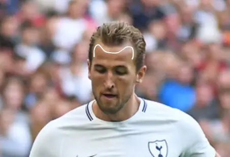 Harry Kane hairline recession