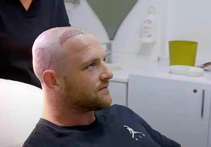 Nick Grigg's hair transplant