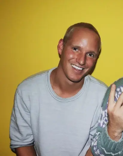 jamie laing before hair transplant