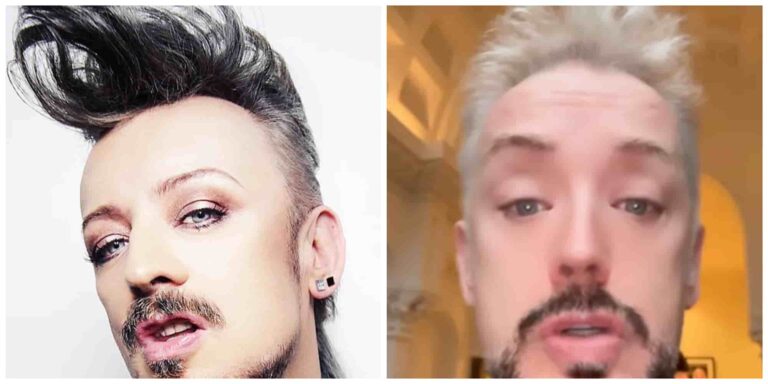 Boy george before and after hair transplant