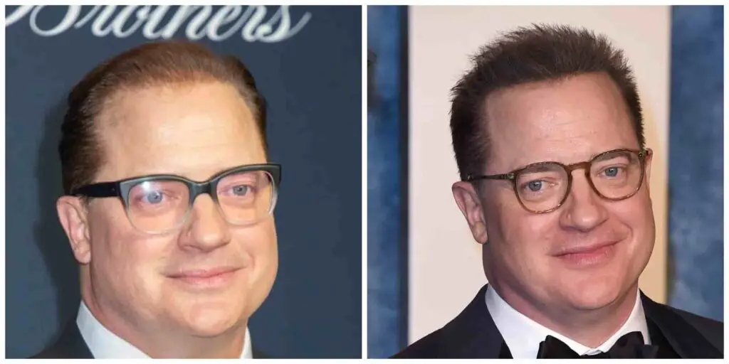 Brendan Fraser possibly second hair transplant