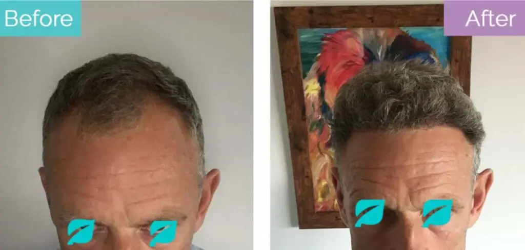 Grey hair transplant