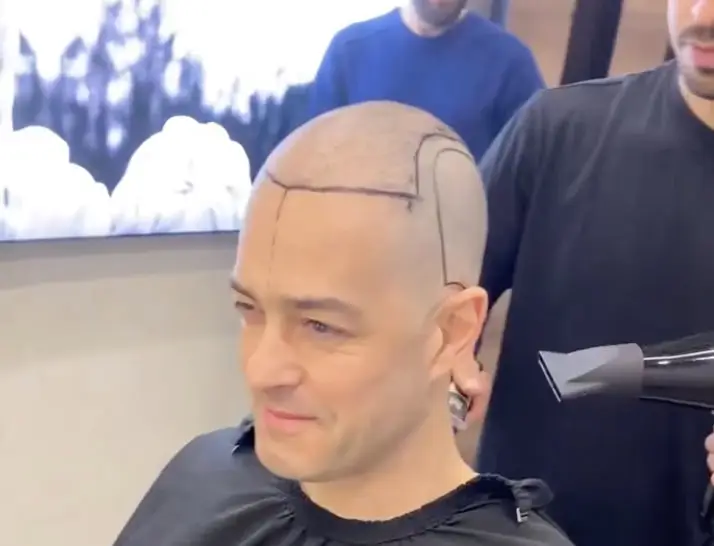 Lee Mead bald hair transplant