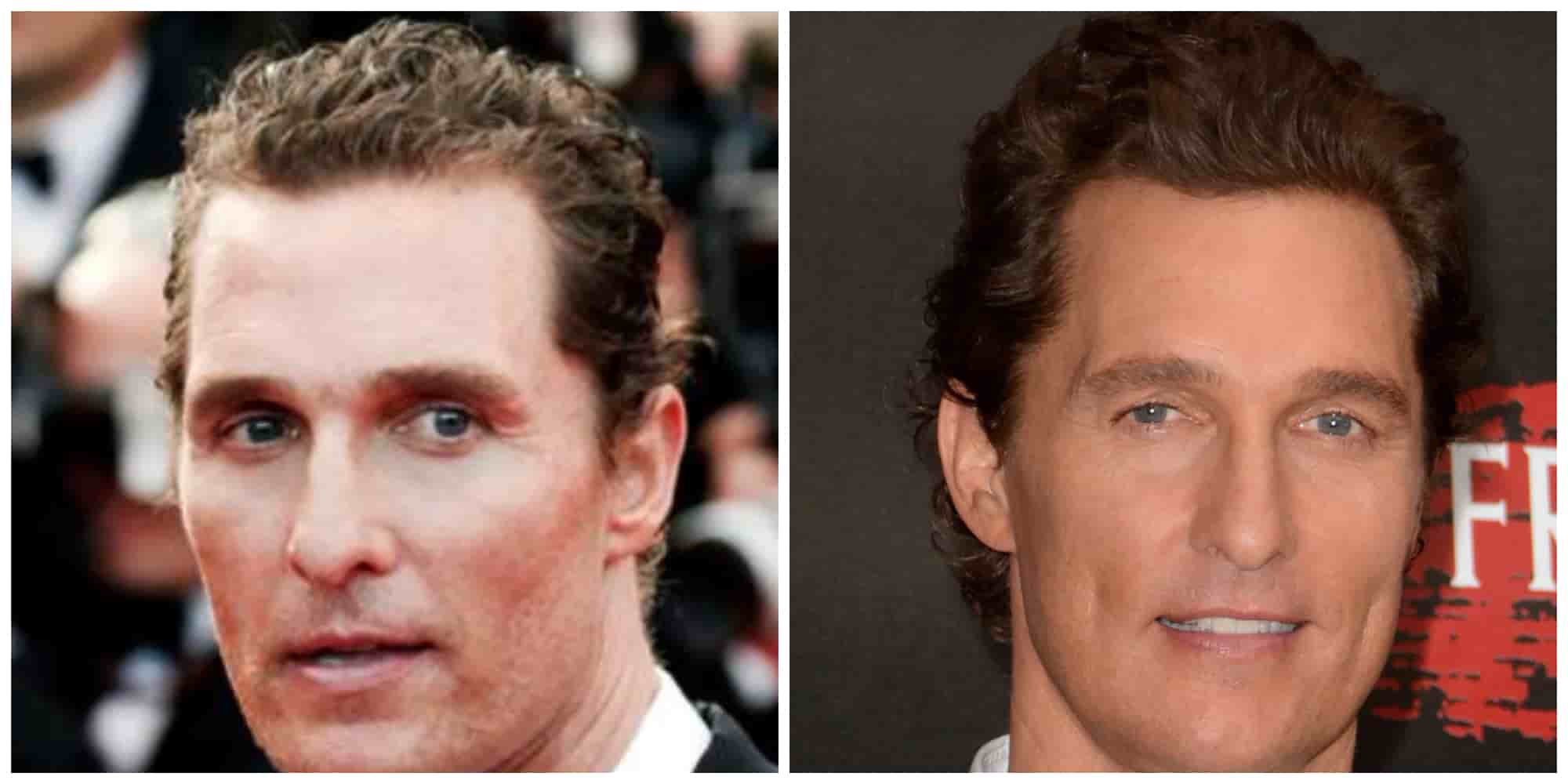 Matthew McConaughey Hair Transplant: The Truth Revealed