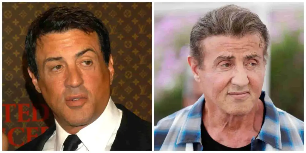 Sylvester Stallone before and ater alleged hair transplant