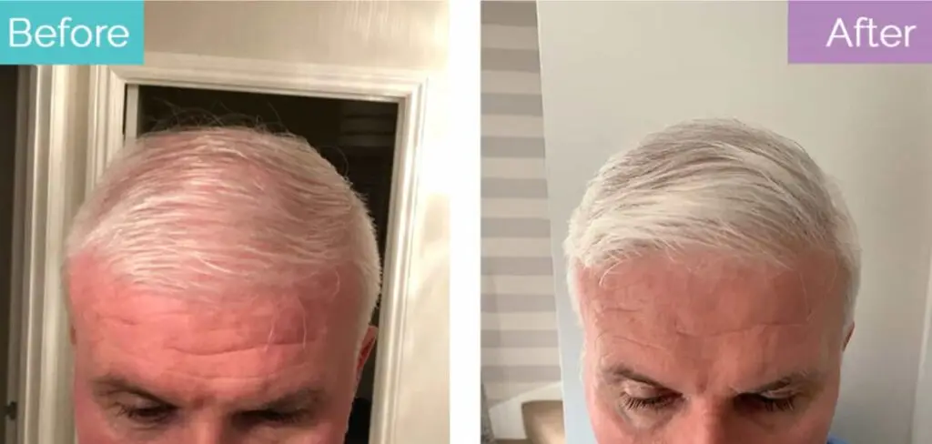 White hair transplant